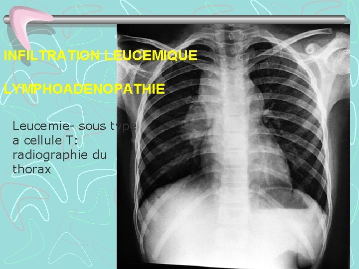 INFILTRATION LEUCEMIQUE LYMPHOADENOPATHIE Leucemie- sous type a cellule T: radiographie du thorax 