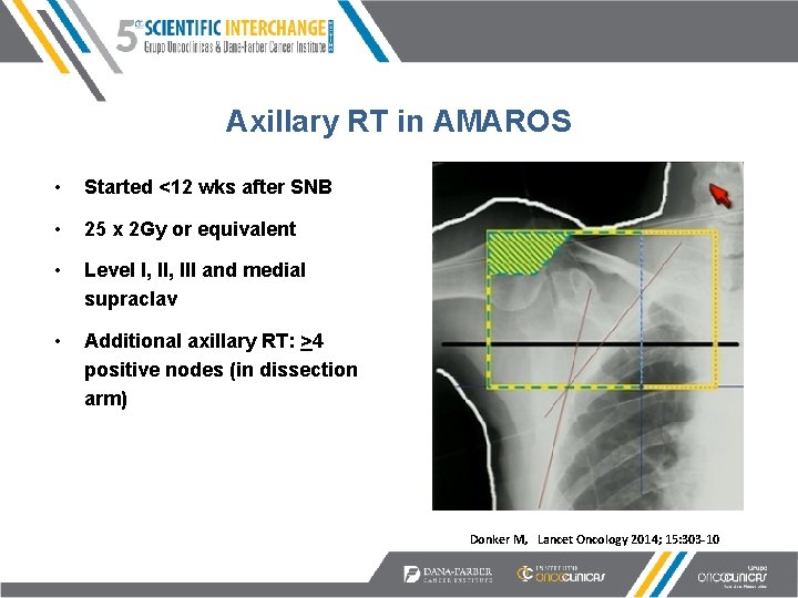 Axillary RT in AMAROS • Started <12 wks after SNB • 25 x 2