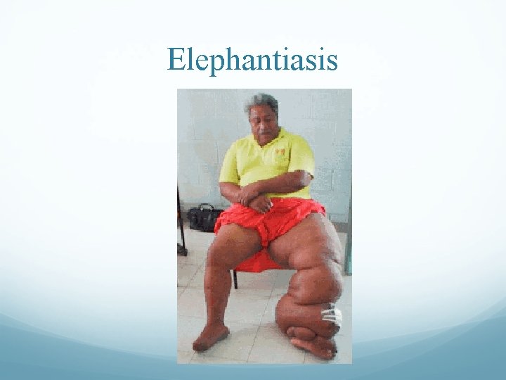 Elephantiasis Elephantiasis