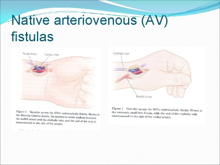 Native arteriovenous (AV) fistulas 