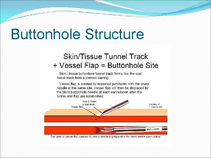 Buttonhole Structure 