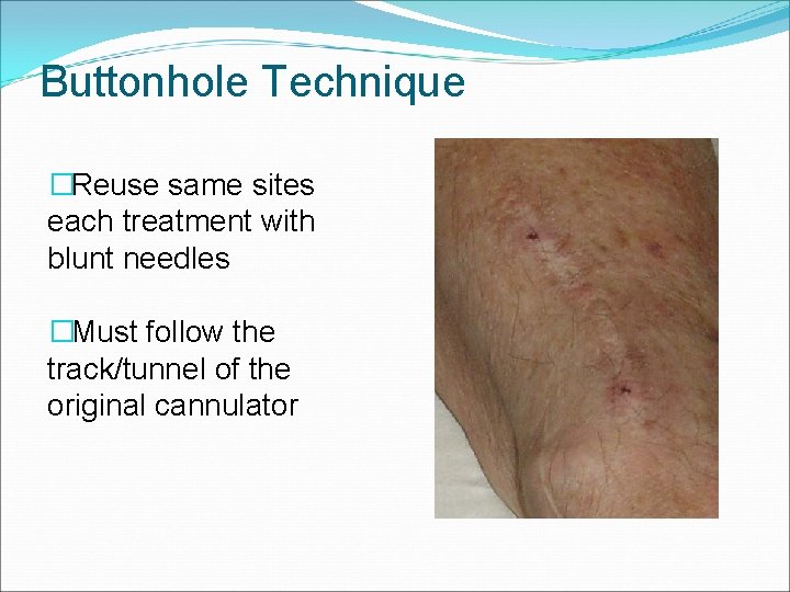 Buttonhole Technique �Reuse same sites each treatment with blunt needles �Must follow the track/tunnel