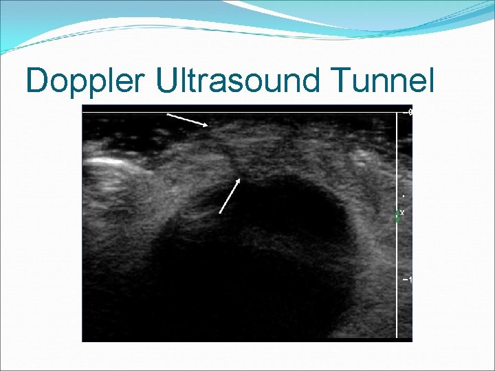 Doppler Ultrasound Tunnel 