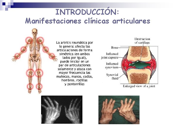 INTRODUCCIÓN: Manifestaciones clínicas articulares INTRODUCCIÓN: Manifestaciones clínicas articulares