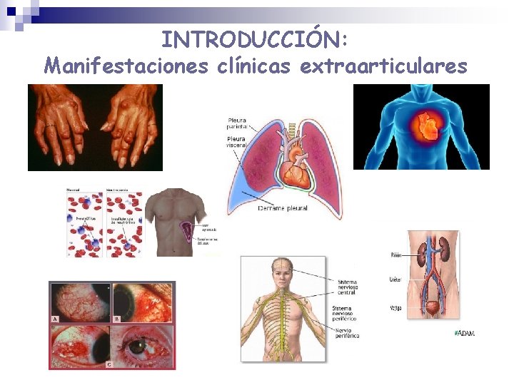 INTRODUCCIÓN: Manifestaciones clínicas extraarticulares INTRODUCCIÓN: Manifestaciones clínicas extraarticulares