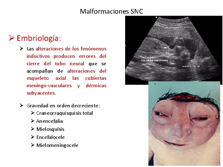 Malformaciones SNC Ø Embriología: Ø Las alteraciones de los fenómenos inductivos producen errores del