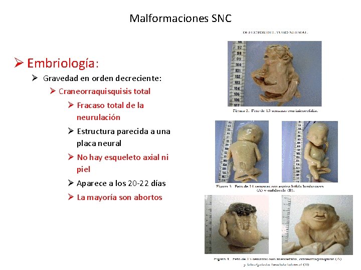 Malformaciones SNC Ø Embriología: Ø Gravedad en orden decreciente: Ø Craneorraquisis total Ø Fracaso