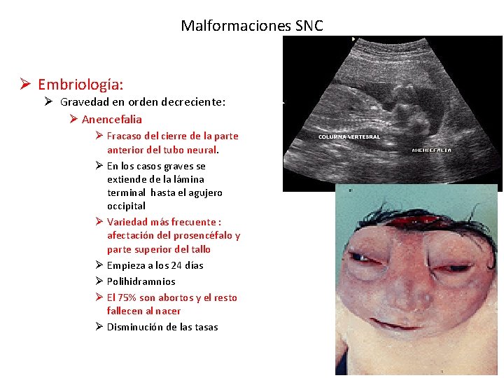 Malformaciones SNC Ø Embriología: Ø Gravedad en orden decreciente: Ø Anencefalia Ø Fracaso del