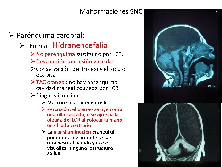 Malformaciones SNC Ø Parénquima cerebral: Ø Forma: Hidranencefalia: Ø No parénquima sustituido por LCR.