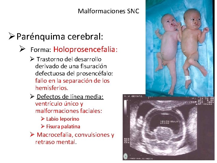 Malformaciones SNC ØParénquima cerebral: Ø Forma: Holoprosencefalia: Ø Trastorno del desarrollo derivado de una