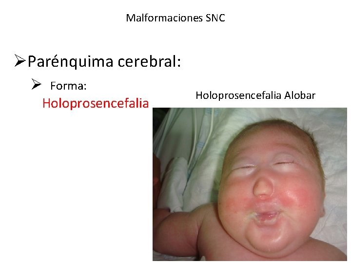 Malformaciones SNC ØParénquima cerebral: Ø Forma: Holoprosencefalia Alobar 