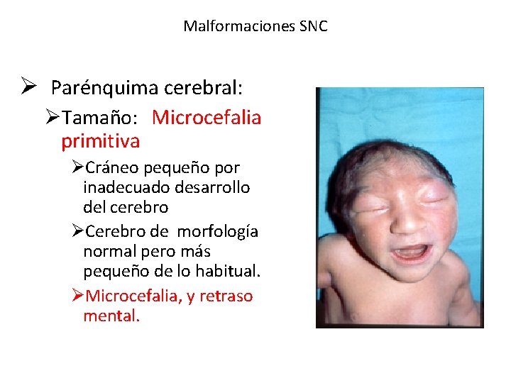 Malformaciones SNC Ø Parénquima cerebral: ØTamaño: Microcefalia primitiva ØCráneo pequeño por inadecuado desarrollo del