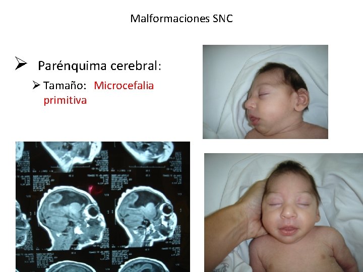 Malformaciones SNC Ø Parénquima cerebral: Ø Tamaño: Microcefalia primitiva 
