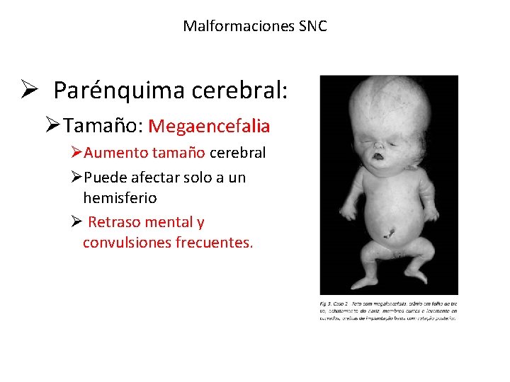 Malformaciones SNC Ø Parénquima cerebral: ØTamaño: Megaencefalia ØAumento tamaño cerebral ØPuede afectar solo a