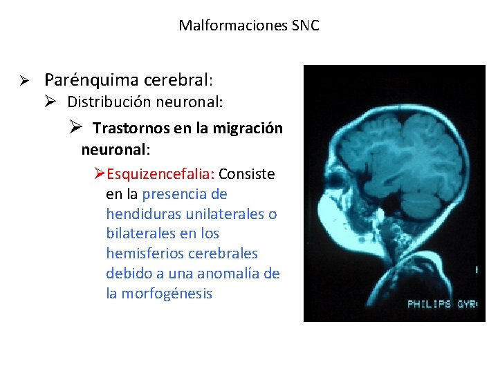 Malformaciones SNC Ø Parénquima cerebral: Ø Distribución neuronal: Ø Trastornos en la migración neuronal: