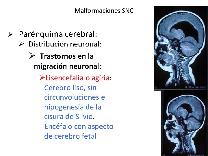 Malformaciones SNC Ø Parénquima cerebral: Ø Distribución neuronal: Ø Trastornos en la migración neuronal: