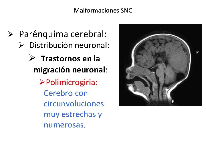 Malformaciones SNC Ø Parénquima cerebral: Ø Distribución neuronal: Ø Trastornos en la migración neuronal: