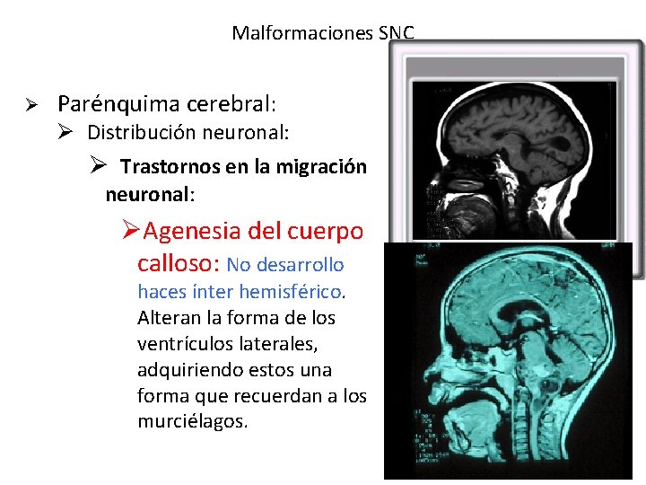 Malformaciones SNC Ø Parénquima cerebral: Ø Distribución neuronal: Ø Trastornos en la migración neuronal: