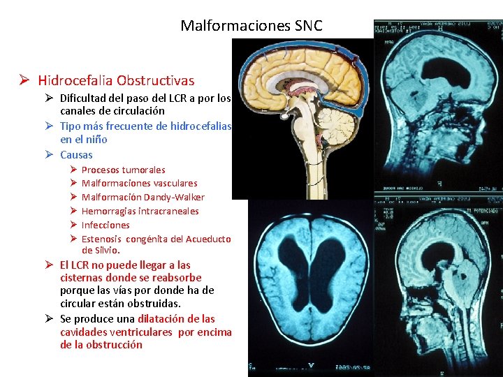 Malformaciones SNC Ø Hidrocefalia Obstructivas Ø Dificultad del paso del LCR a por los