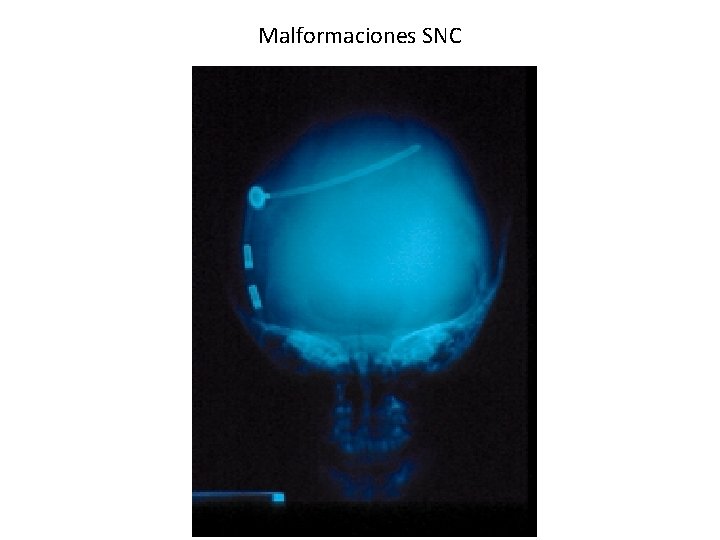 Malformaciones SNC 