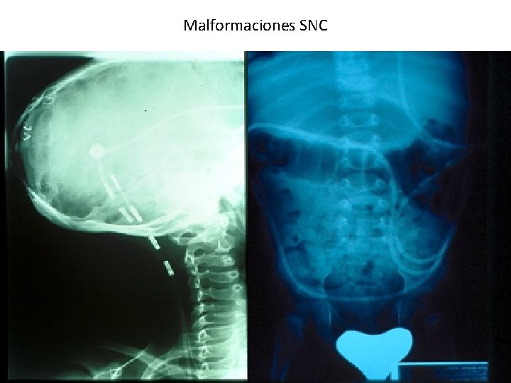 Malformaciones SNC 