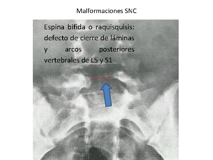 Malformaciones SNC Espina bifida o raquisis: defecto de cierre de láminas y arcos posteriores