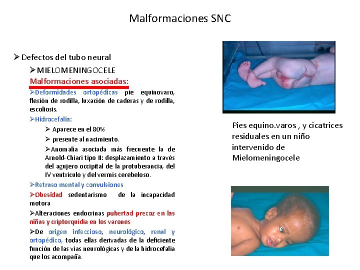 Malformaciones SNC ØDefectos del tubo neural ØMIELOMENINGOCELE Malformaciones asociadas: ØDeformidades ortopédicas pie equinovaro, flexión