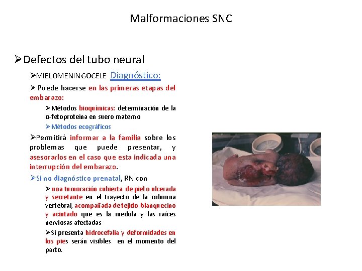 Malformaciones SNC ØDefectos del tubo neural ØMIELOMENINGOCELE Diagnóstico: Ø Puede hacerse en las primeras