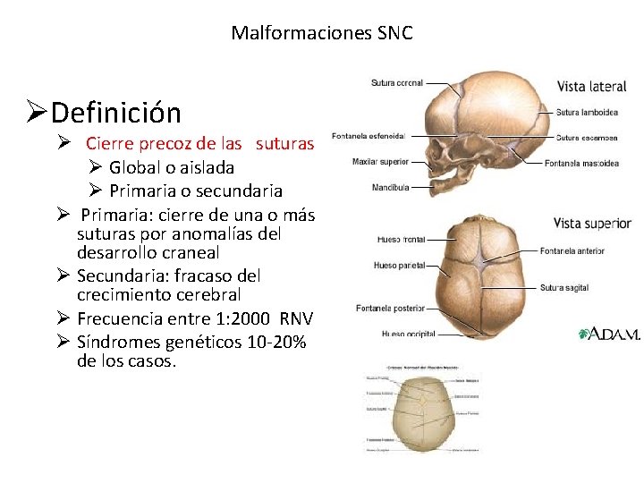 Malformaciones SNC ØDefinición Ø Cierre precoz de las suturas Ø Global o aislada Ø