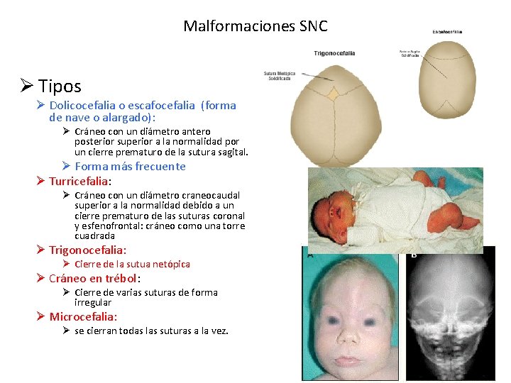 Malformaciones SNC Ø Tipos Ø Dolicocefalia o escafocefalia (forma de nave o alargado): Ø