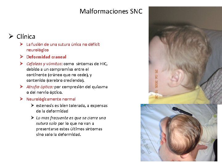 Malformaciones SNC Ø Clínica Ø La fusión de una sutura única no déficit neurológico