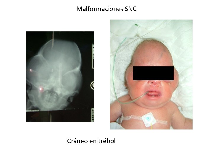 Malformaciones SNC Cráneo en trébol 