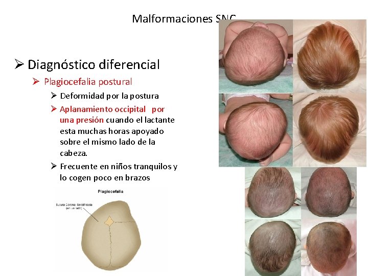 Malformaciones SNC Ø Diagnóstico diferencial Ø Plagiocefalia postural Ø Deformidad por la postura Ø