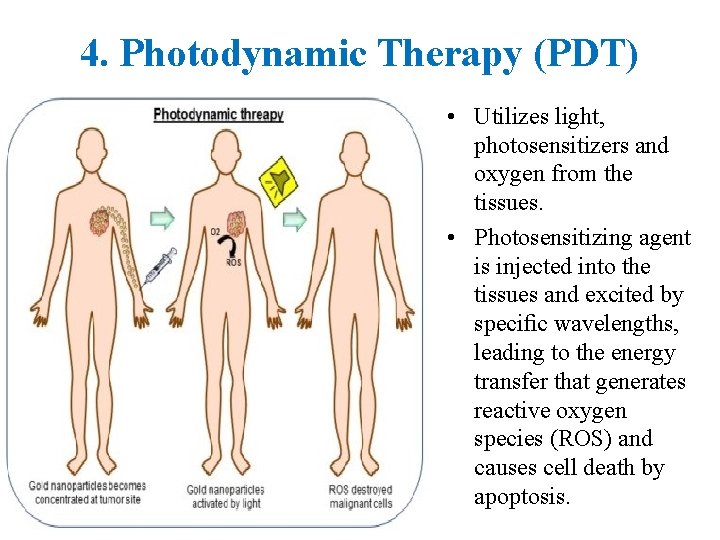 4. Photodynamic Therapy (PDT) • Utilizes light, photosensitizers and oxygen from the tissues. •