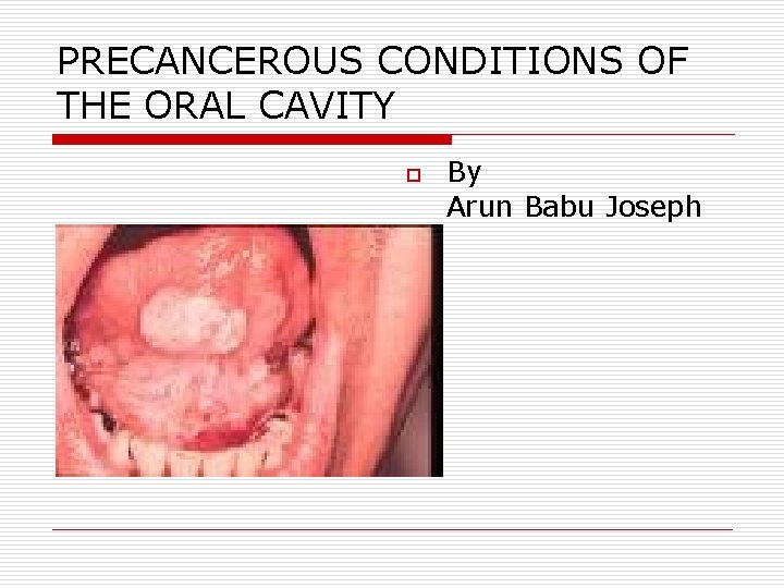 PRECANCEROUS CONDITIONS OF THE ORAL CAVITY o By Arun Babu Joseph 