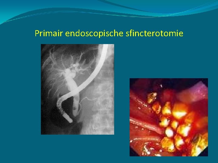 Primair endoscopische sfincterotomie 