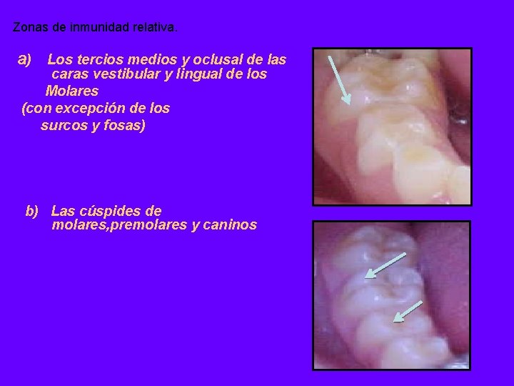 Zonas de inmunidad relativa. a) Los tercios medios y oclusal de las caras vestibular