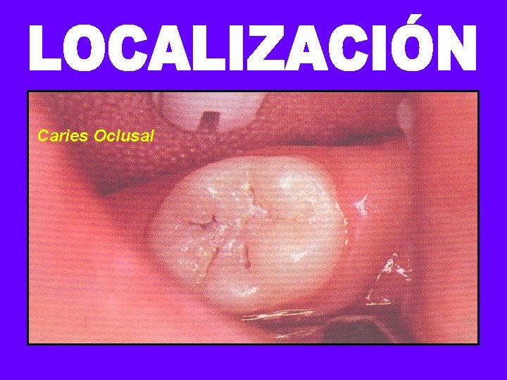 Caries Oclusal 