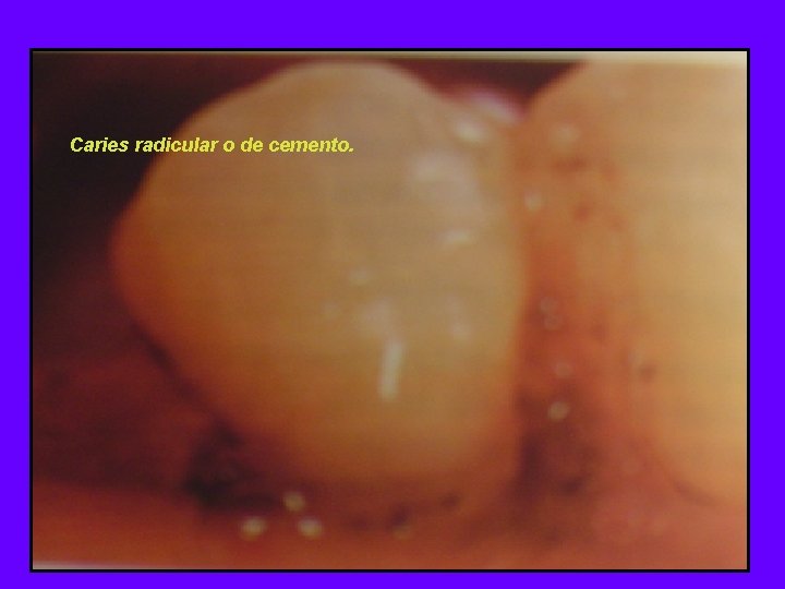 Caries radicular o de cemento. 