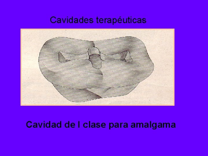 Cavidades terapéuticas Cavidad de I clase para amalgama 