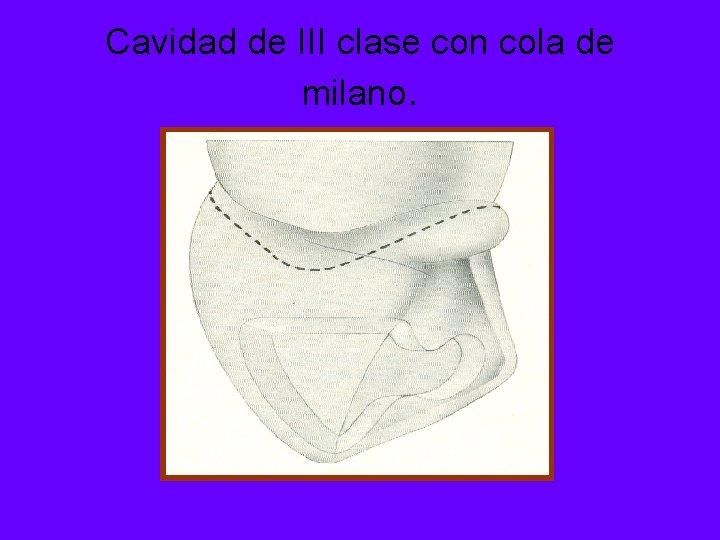 Cavidad de III clase con cola de milano. 