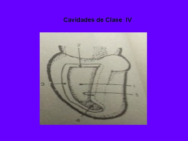 Cavidades de Clase IV 