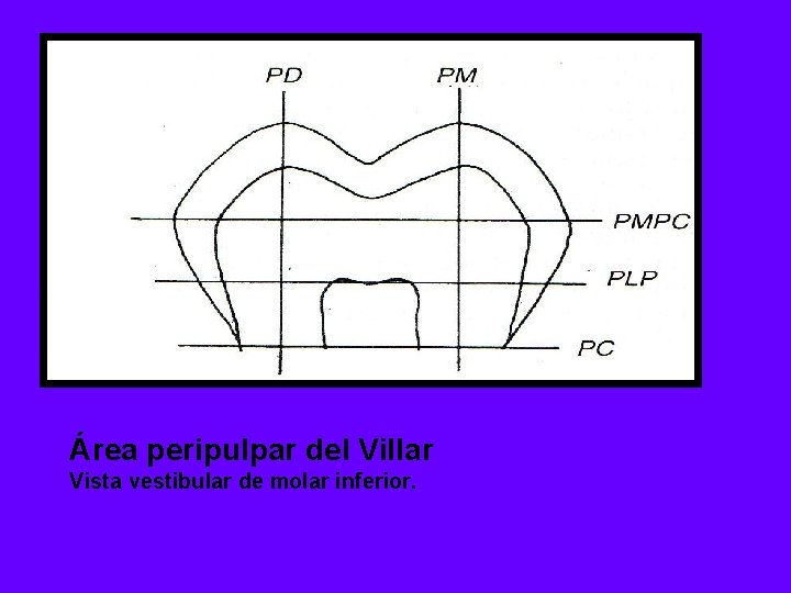 Área peripulpar del Villar Vista vestibular de molar inferior. 