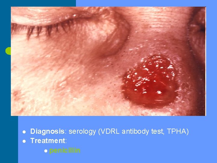 l l Diagnosis: serology (VDRL antibody test, TPHA) Treatment: l penicillin 