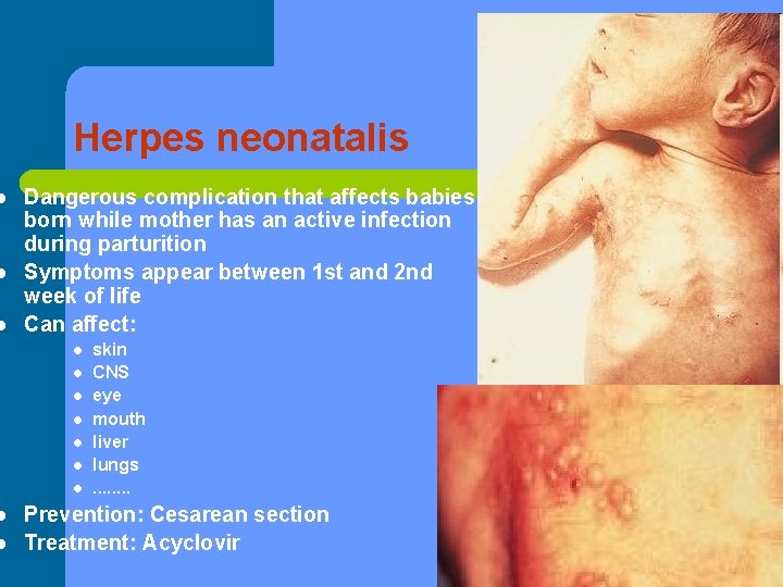 l l l Herpes neonatalis Dangerous complication that affects babies born while mother has