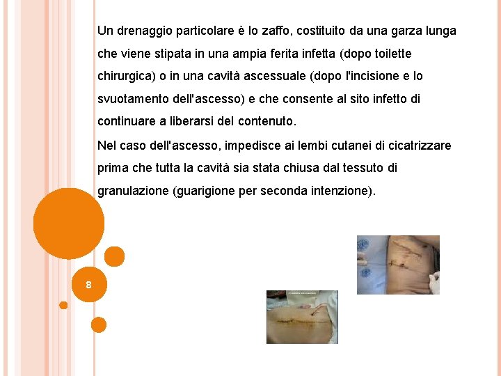 Un drenaggio particolare è lo zaffo, costituito da una garza lunga che viene stipata Un drenaggio particolare è lo zaffo, costituito da una garza lunga che viene stipata