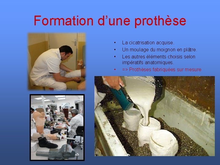 Formation d’une prothèse • • La cicatrisation acquise. Un moulage du moignon en plâtre.