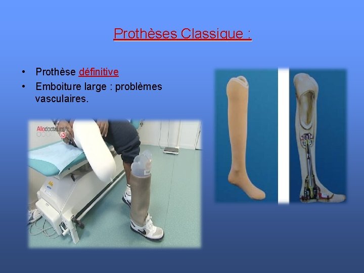 Prothèses Classique : • Prothèse définitive • Emboiture large : problèmes vasculaires. 