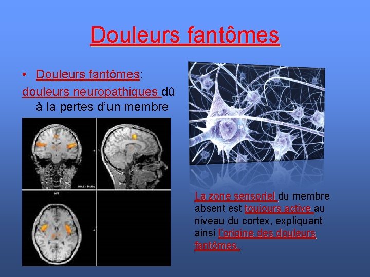 Douleurs fantômes • Douleurs fantômes: Douleurs fantômes douleurs neuropathiques dû douleurs neuropathiques à la