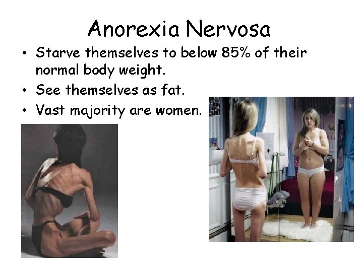 Anorexia Nervosa • Starve themselves to below 85% of their normal body weight. •